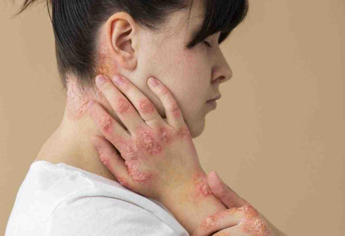 ayurvedic medicine for skin allergy