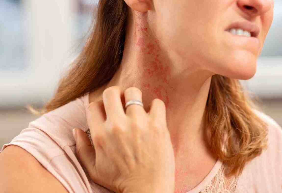 ayurvedic medicine for skin allergy
