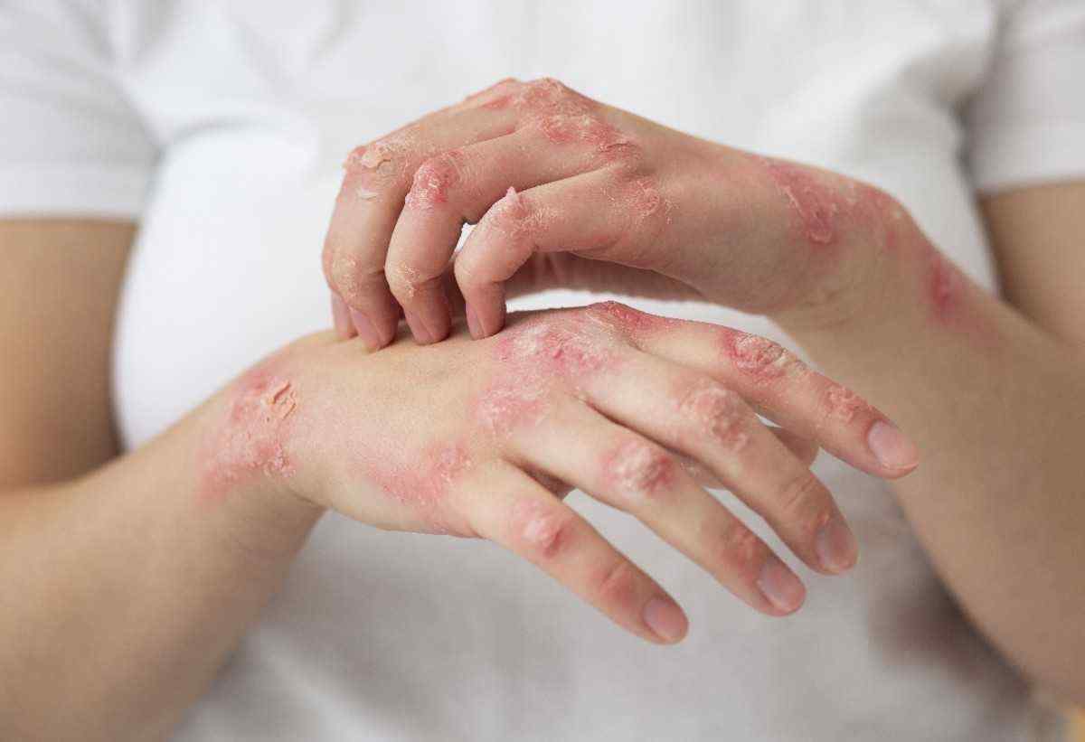 ayurvedic medicine for skin allergy