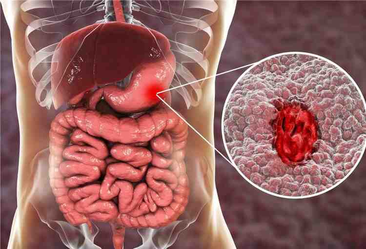 Ayurvedic treatment for digestive disorders