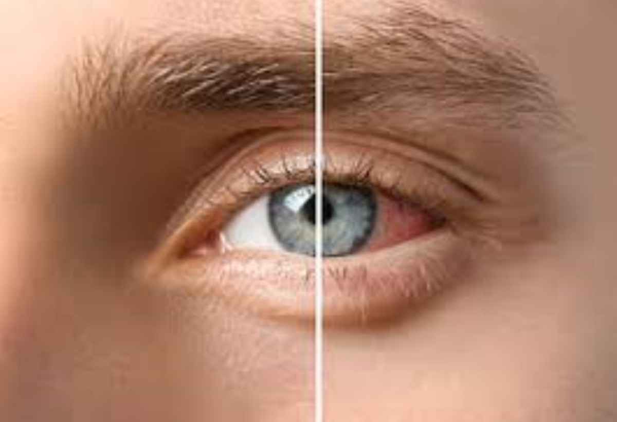 Netra Tarpana Ayurvedic Eye Treatment