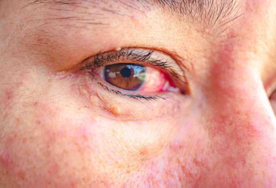 Natural Remedies for Eye Health