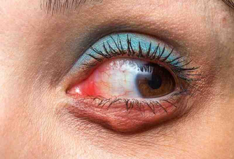 Natural Remedies for Eye Health