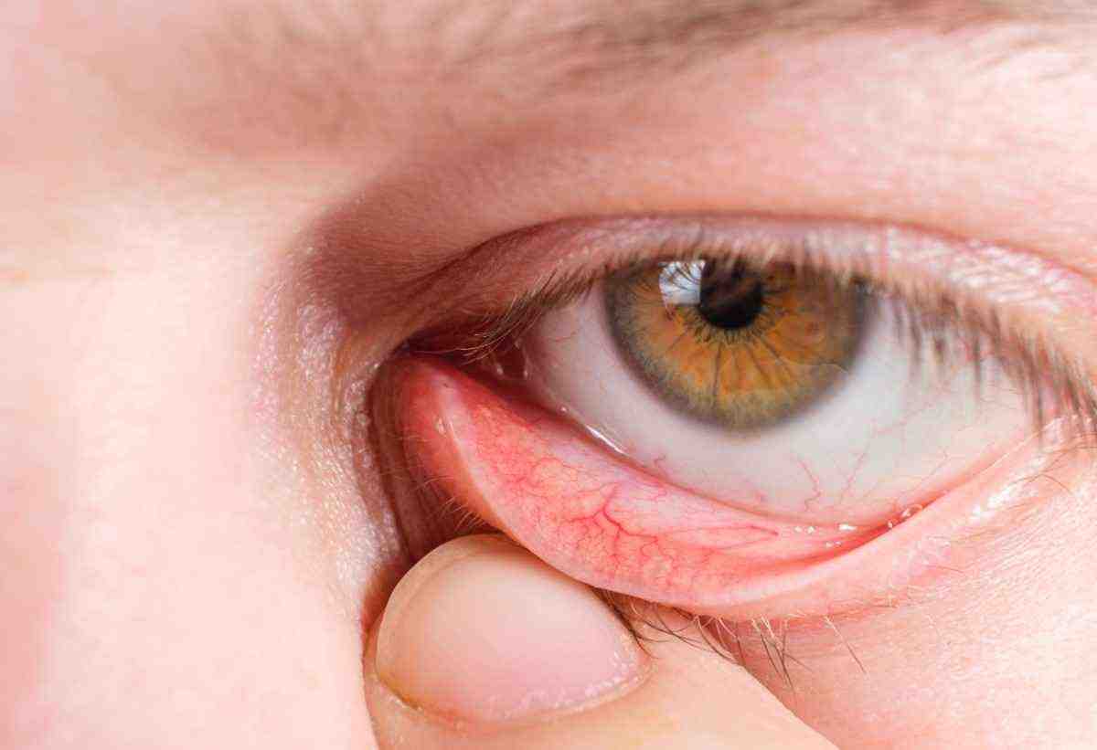 Natural Remedies for Eye Health